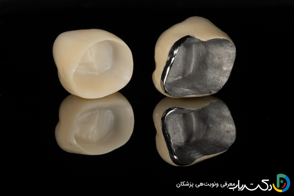 روکش PFM (فلز-سرامیک) چیست؟