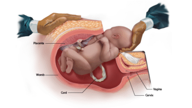 سزارین چیست و چگونه انجام میشود؟