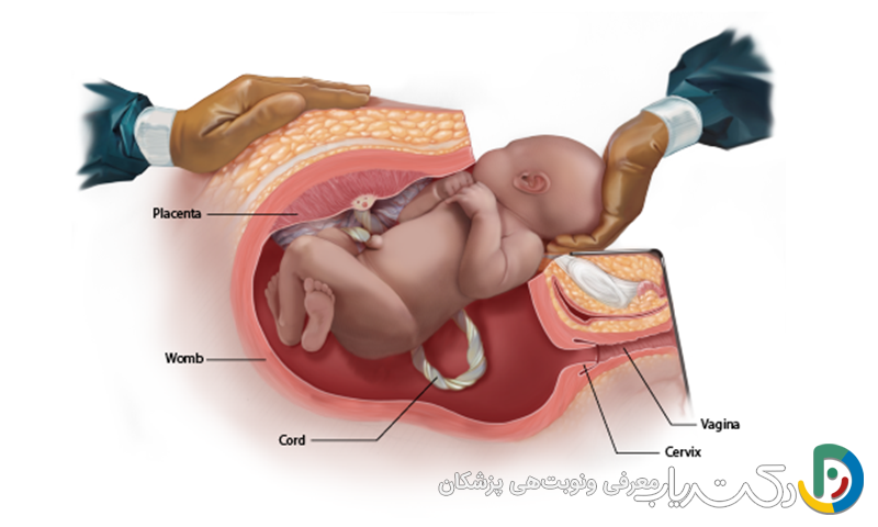 سزارین چیست و چگونه انجام می‌شود؟