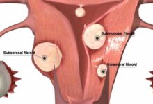 عمل میومکتومی چیست؟