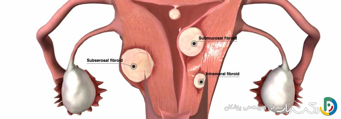 عمل میومکتومی چیست؟