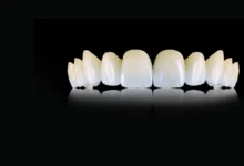 روکش زیرکونیا چیست و چه مزایایی دارد؟