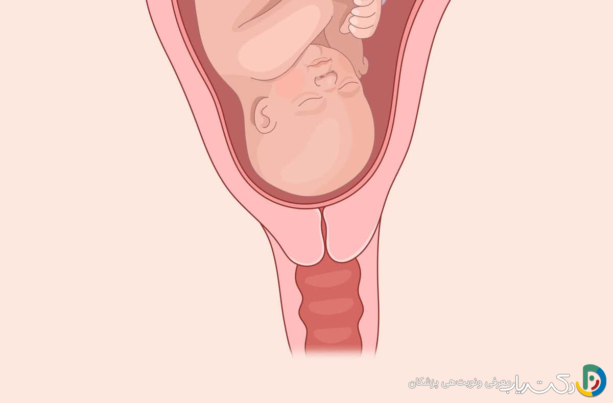 سرکلاژ اورژانسی یا نجات (Rescue) چیست؟