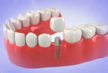 ایمپلنت فوری یا یک روزه چیست و برای چه کسانی مناسب است؟