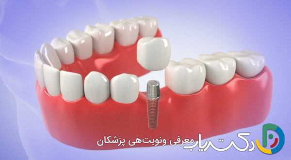 ایمپلنت فوری یا یک روزه چیست و برای چه کسانی مناسب است؟