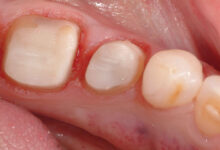 ترمیم دندان به روش بیلدآپ Build up چیست؟