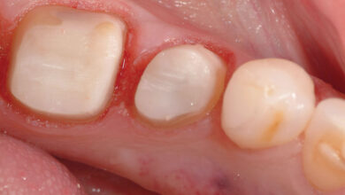 ترمیم دندان به روش بیلدآپ Build up چیست؟