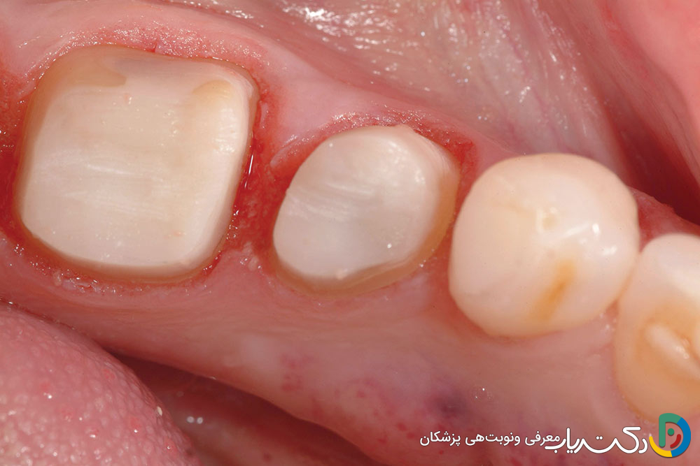 ترمیم دندان به روش بیلدآپ Build up چیست؟