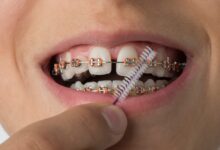 ارتودنسی ثابت چیست؟ راهنمای کامل برای داشتن لبخندی زیبا و مرتب