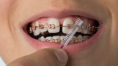 ارتودنسی ثابت چیست؟ راهنمای کامل برای داشتن لبخندی زیبا و مرتب