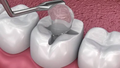 گلاس آینومر چیست و در چه مواردی استفاده می شود؟