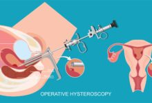 هیستروسکوپی چیست و چگونه انجام میشود؟