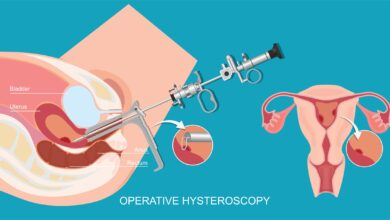 هیستروسکوپی چیست و چگونه انجام میشود؟