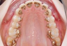 ارتودنسی لینگوال پشت دندانی چیست؟