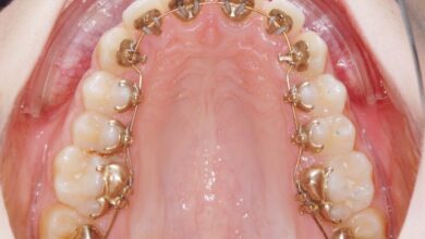 ارتودنسی لینگوال پشت دندانی چیست؟