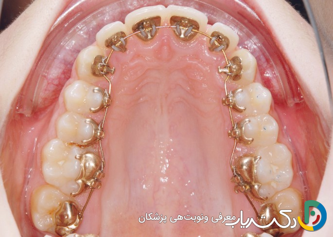 ارتودنسی لینگوال پشت دندانی چیست؟