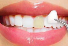 بهترین برند روکش زیرکونیا چیست؟ آلمانی، آمریکایی