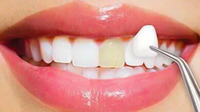 بهترین برند روکش زیرکونیا چیست؟ آلمانی، آمریکایی