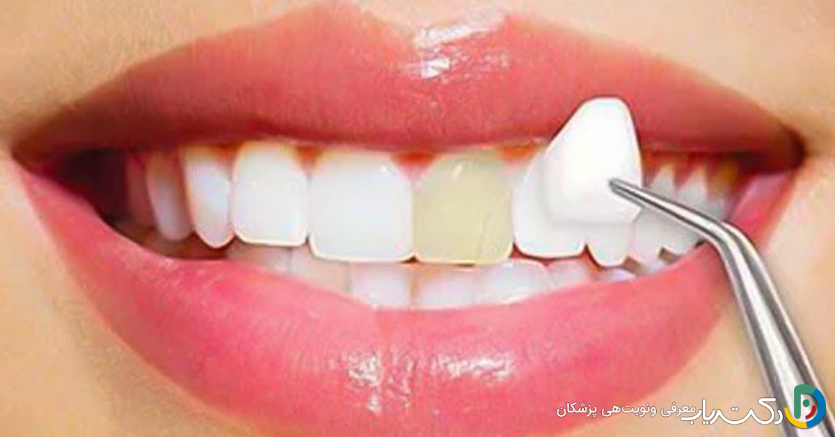 بهترین برند روکش زیرکونیا چیست؟ آلمانی، آمریکایی