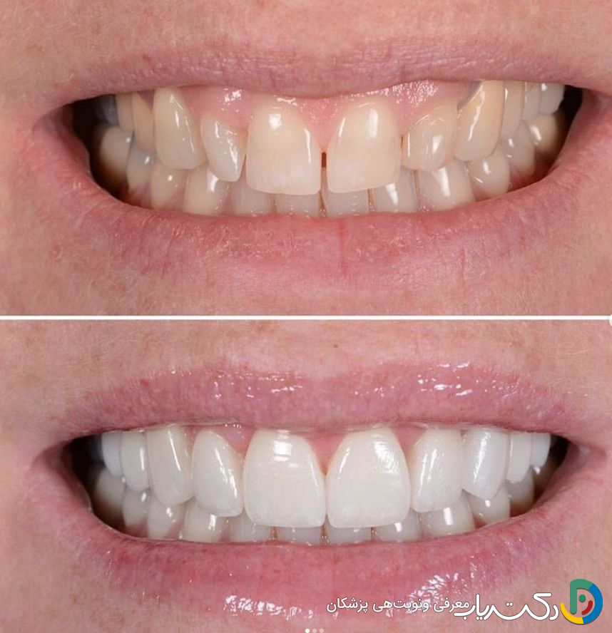 حداقل سن برای انجام کامپوزیت چقدر است؟