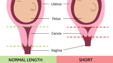 طول سرویکس نرمال در بارداری چقدر است؟