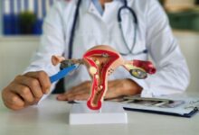 مراقبت های بعد از عمل هیستروسکوپی چیست؟