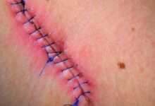 اگر مشکوک به عفونت زخم لاپاراسکوپی شدم چه کار کنم؟