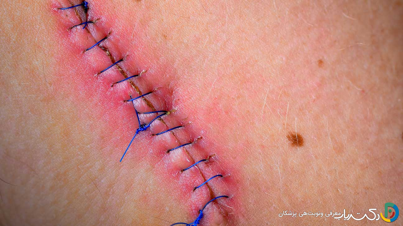 اگر مشکوک به عفونت زخم لاپاراسکوپی شدم چه کار کنم؟