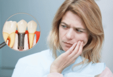 برای کاهش درد بعد از جراحی ایمپلنت چه باید کرد؟