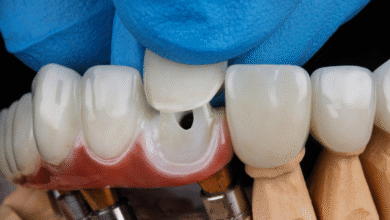 اگر روکش دندان لق شد یا افتاد چه کار کنیم؟
