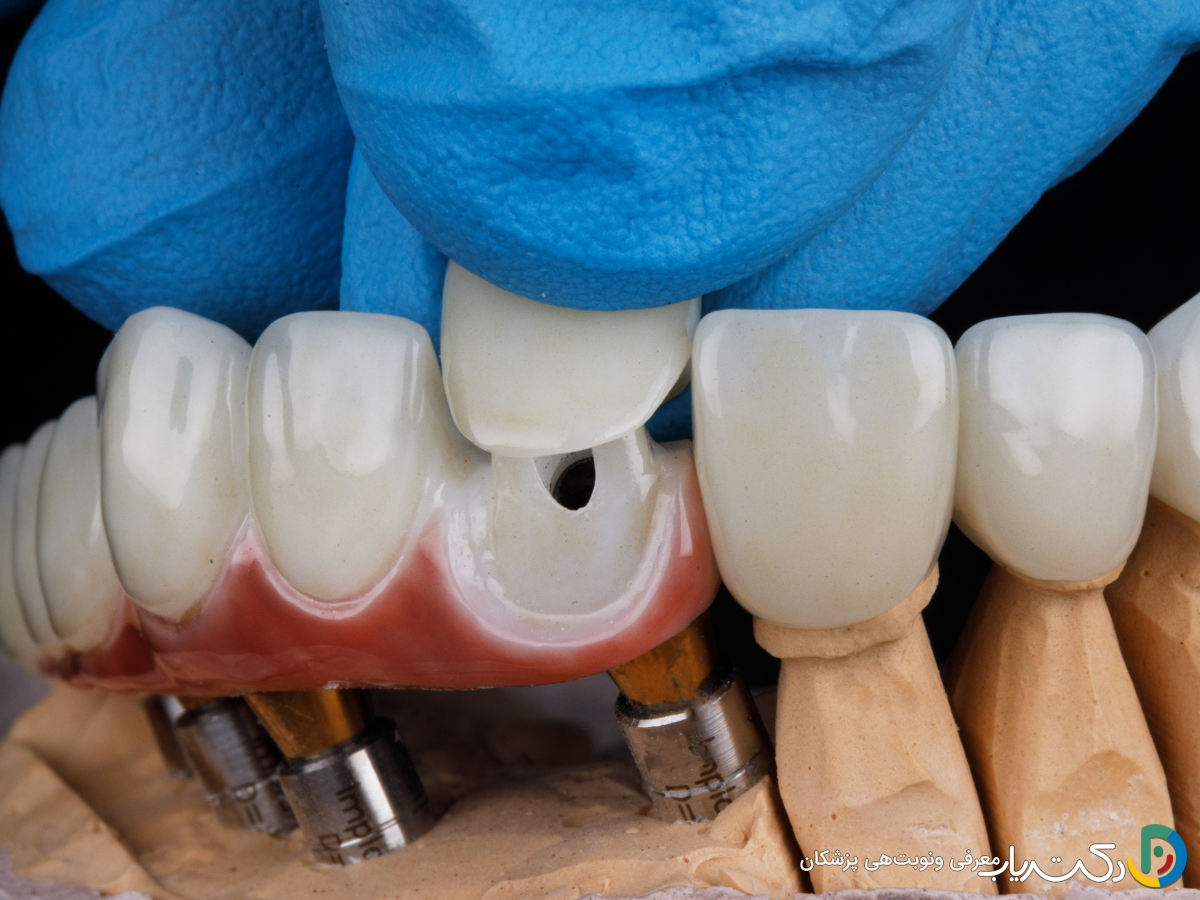 اگر روکش دندان لق شد یا افتاد چه کار کنیم؟