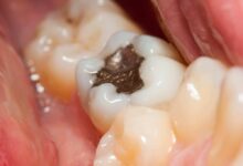 اگر مواد پر کردگی دندان افتاد چه کنیم؟
