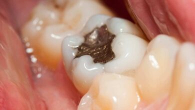 اگر مواد پر کردگی دندان افتاد چه کنیم؟