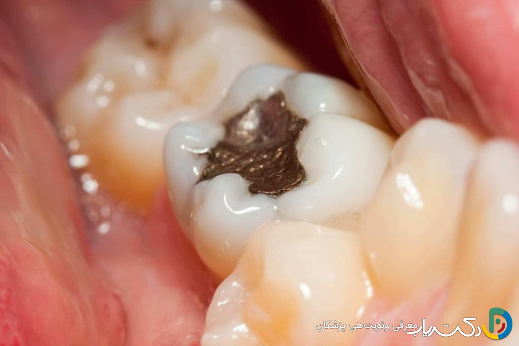 اگر مواد پر کردگی دندان افتاد چه کنیم؟