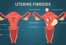 چه زمانی فیبروم نیاز به عمل جراحی دارد؟