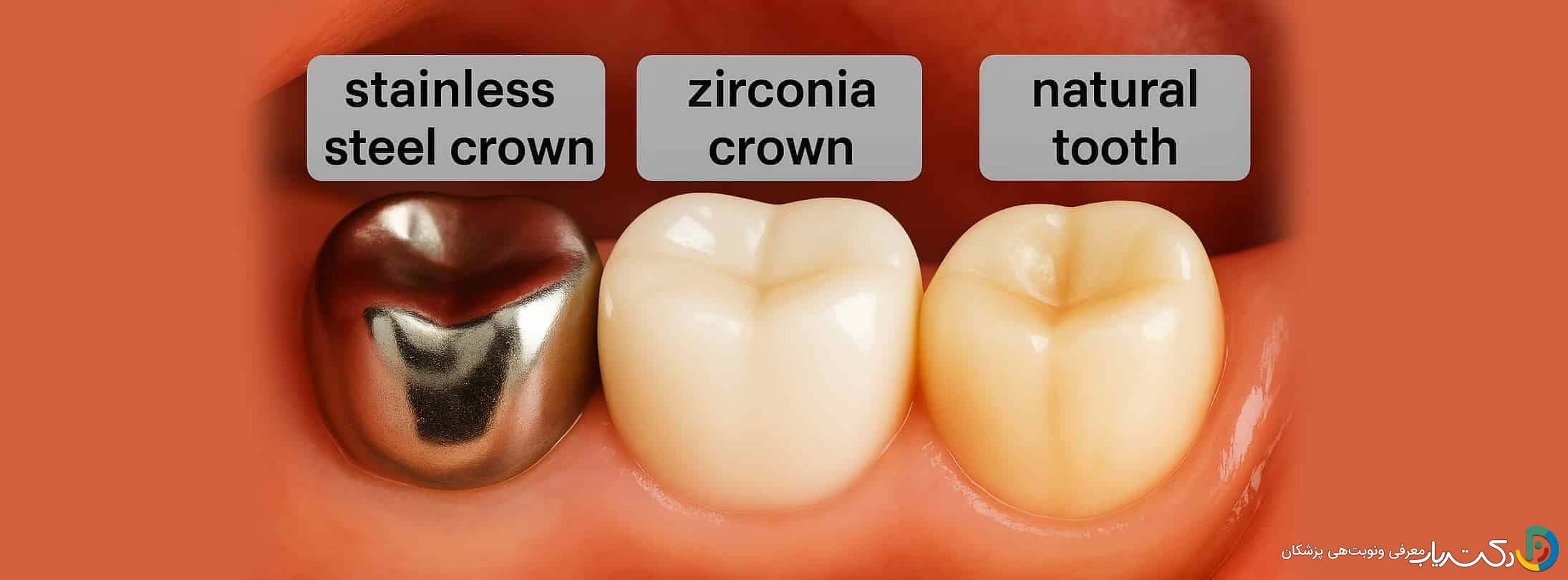 برای دندان های عقب کدام روکش مقاوم تر است؟