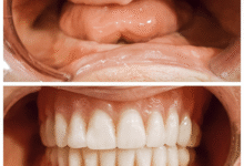 کدام نوع دندان مصنوعی ظاهر طبیعی تری دارد؟