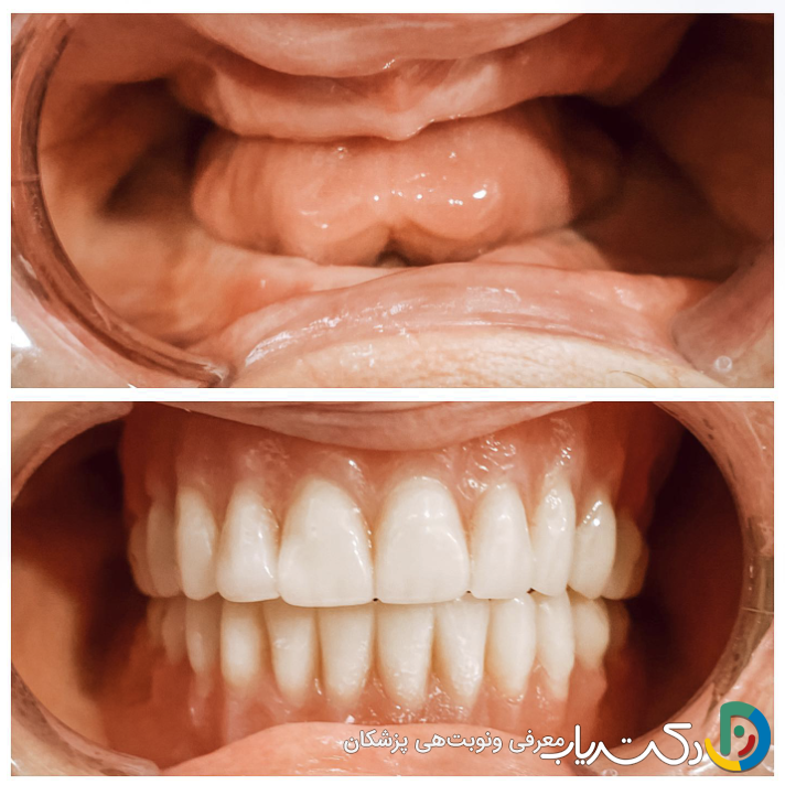 کدام نوع دندان مصنوعی ظاهر طبیعی تری دارد؟