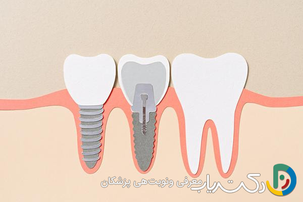 کدام نوع روکش برای ایمپلنت بهتر است؟