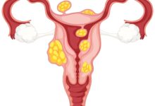 آیا فیبروم بعد از عمل دوباره برمیگردد (عود میکند)؟