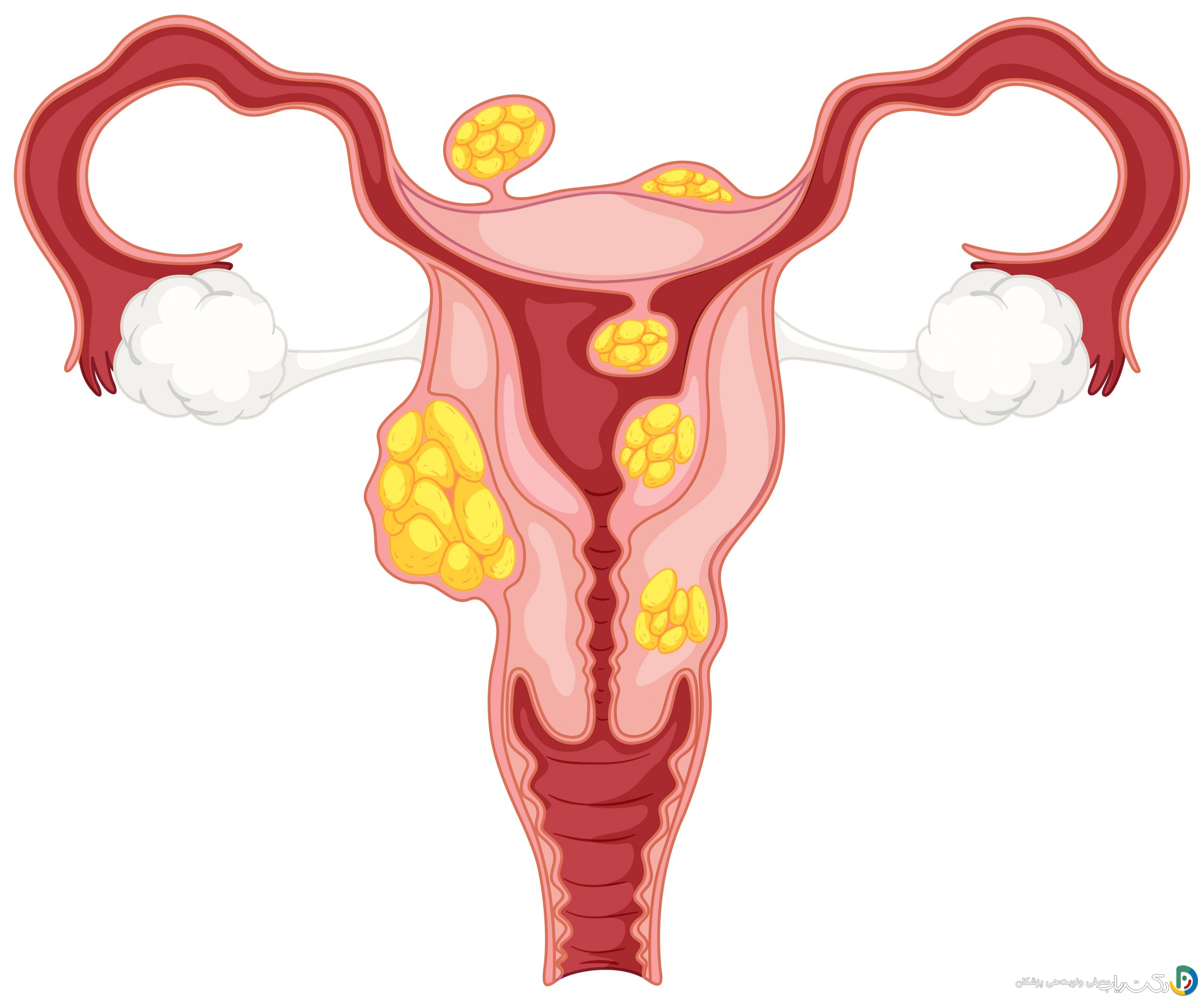 آیا فیبروم بعد از عمل دوباره برمیگردد (عود میکند)؟