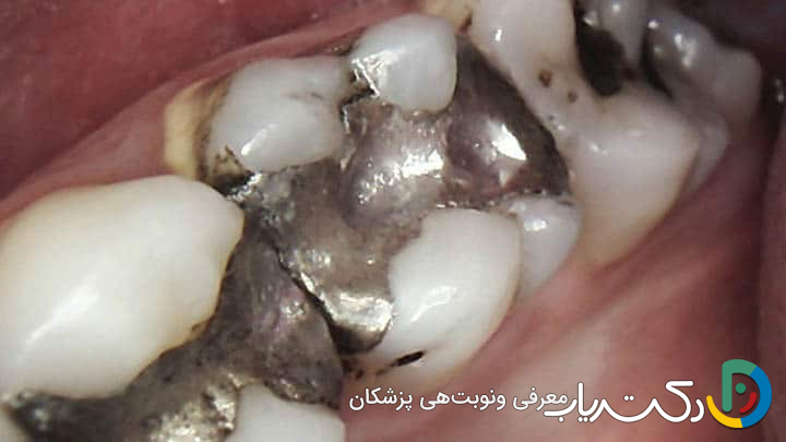 آیا مواد آمالگام نقره ای به دلیل داشتن جیوه سمی و مضر هستند؟
