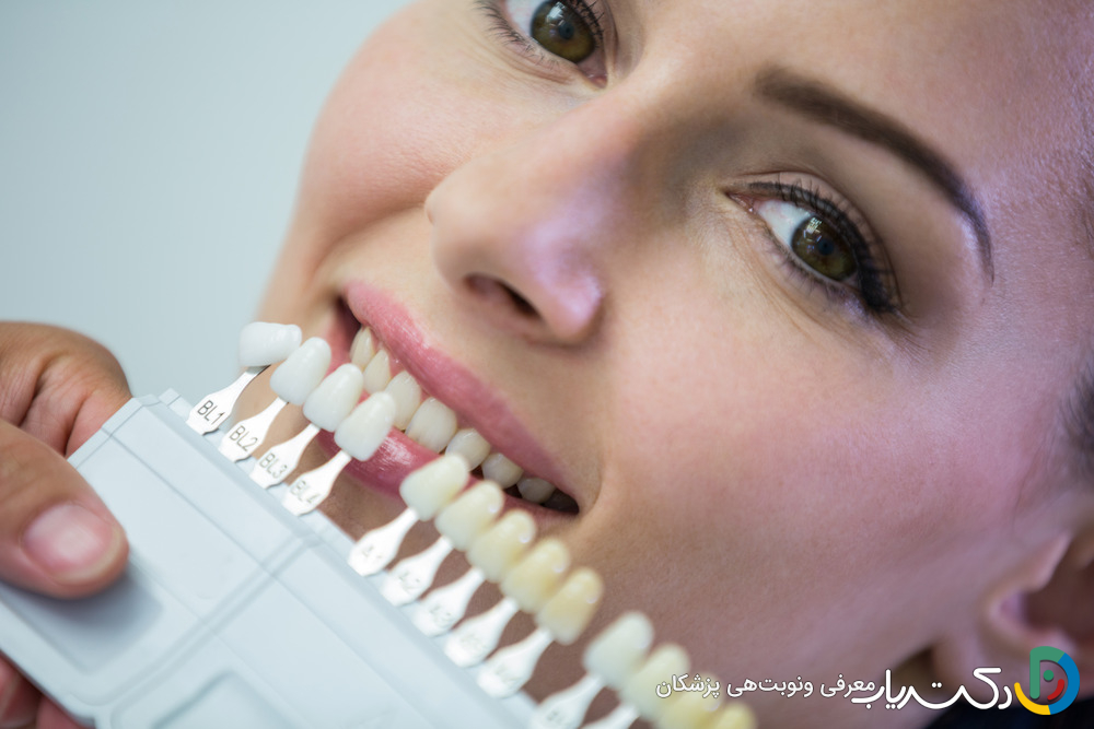 کدام برند کامپوزیت کمترین تغییر رنگ را دارد؟