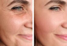 هزینه لیفت صورت در تهران (جدول قیمت 1404)