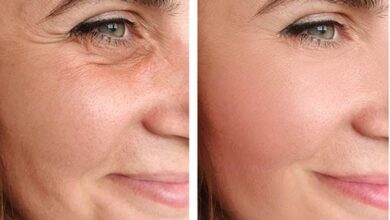 هزینه لیفت صورت در تهران (جدول قیمت 1404)