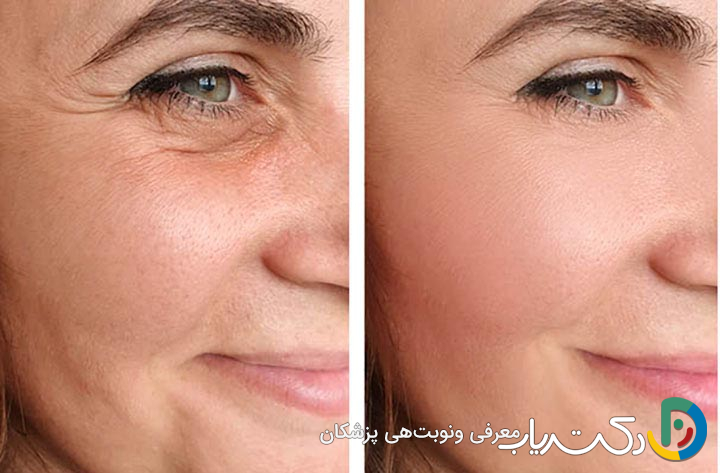 هزینه لیفت صورت در تهران (جدول قیمت 1404)