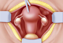 آیا انجام هیسترکتومی بر روی زندگی جنسی تأثیر می گذارد؟