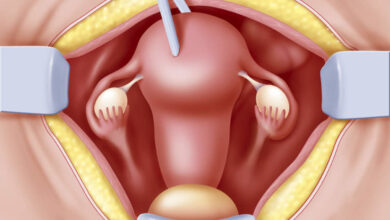 آیا انجام هیسترکتومی بر روی زندگی جنسی تأثیر می گذارد؟