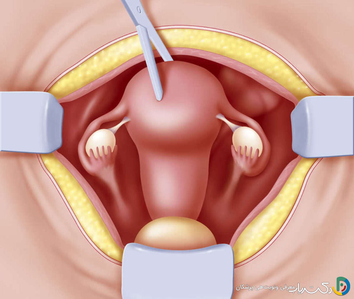 آیا انجام هیسترکتومی بر روی زندگی جنسی تأثیر می گذارد؟