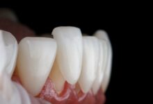 روکش تمام سرامیک چیست؟ (ایمکس با فناوری CAD/CAM)